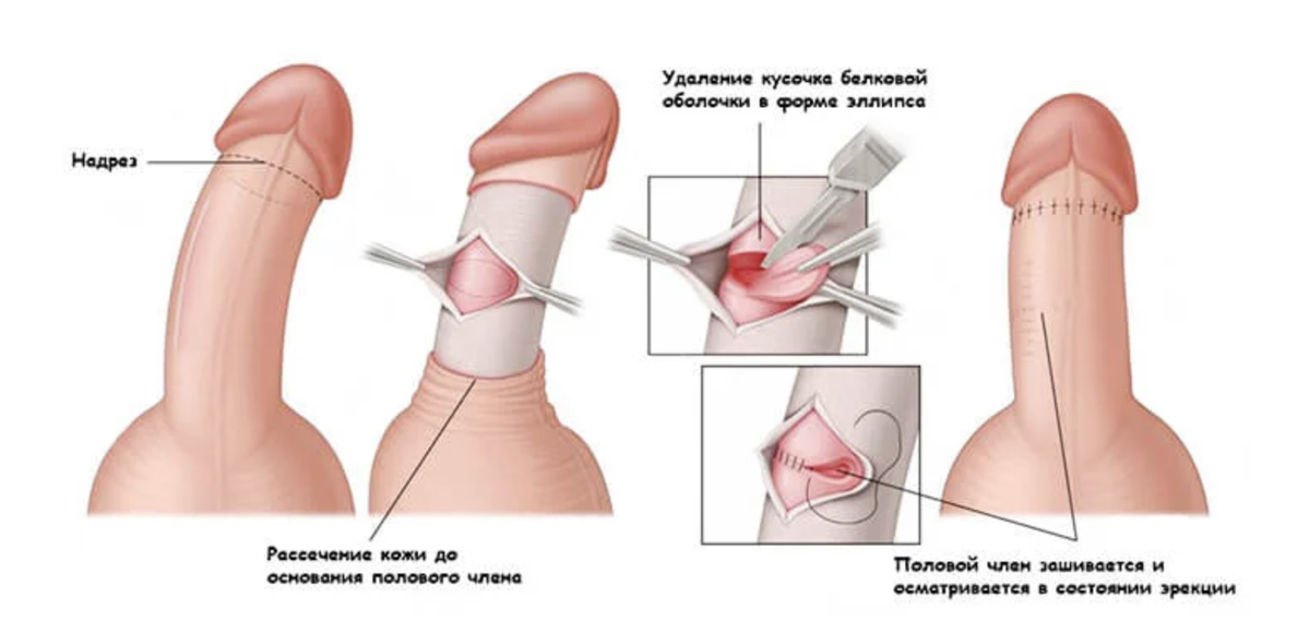 Проблемы искривления полового члена: причины, виды и актуальные методы коррекции